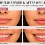 Lip Flip Before and After Smile