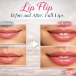 Lip Flip Before and After Full Lips