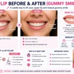 Lip Flip Before and After Gummy Smile