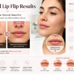 Natural Lip Flip Results