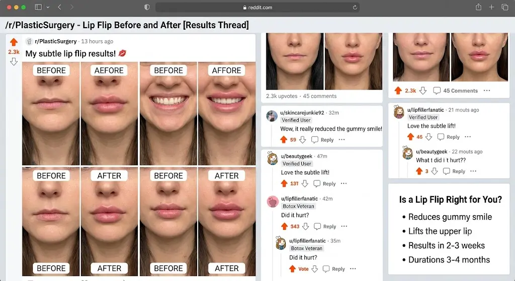 Lip Flip Before and After Reddit