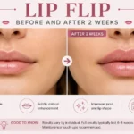 Lip Flip Before and After 2 Weeks