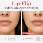 Lip Flip Before and After 3 Months