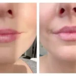 Can You Make a Lip Flip Last Longer