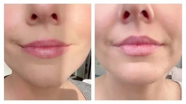Can You Make a Lip Flip Last Longer